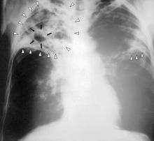 Tuberculosis-x-ray