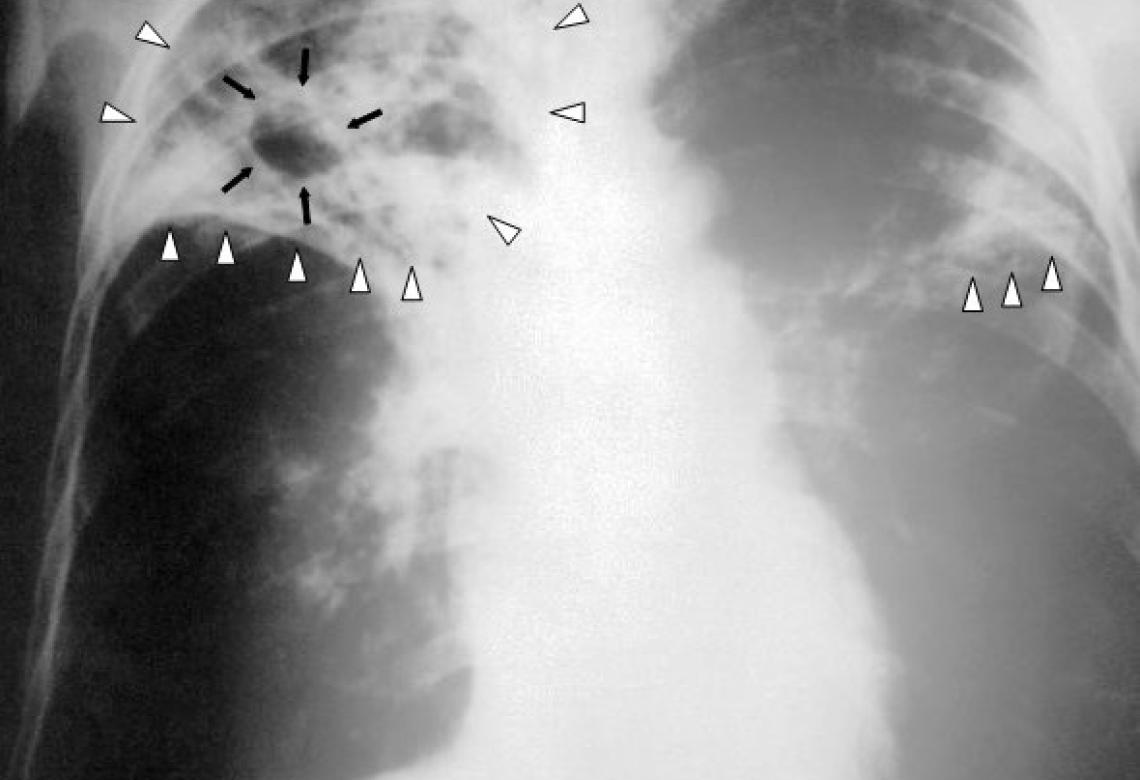 Tuberculosis-x-ray